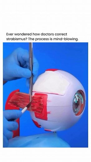 Strabismus Surgery: Restoring Eye Alignment Effectively