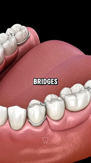 Tooth Replacement Options Explained 🦷 #dentist