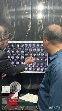 MRI sign of ACL tear #ACLInjury #KneeInjury #sportSurgery