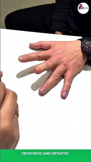 Small steps, big hopes 🌟 Artificial finger bringing confidence back ✋ #HopeInHands"