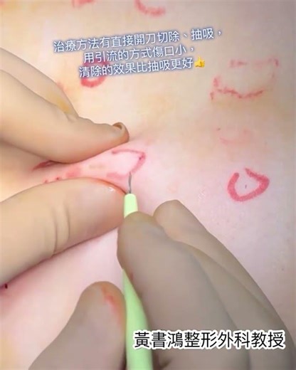 脂肪囊瘤的微創治療新方法👍
