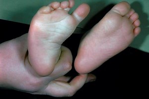 Foot deformities: metatarsus adductus or metatarsus varus