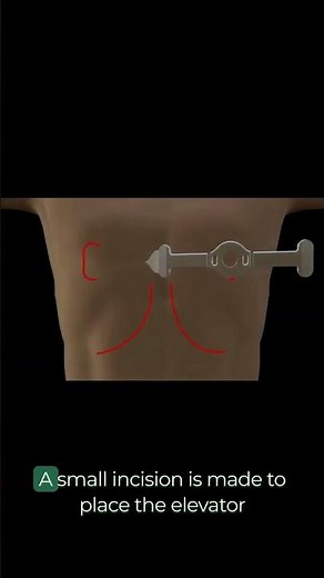 Pectus Up Thecnique for Pectus Excavatum