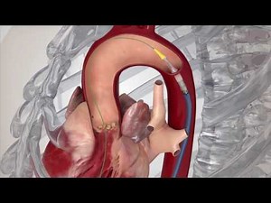 TAVR Transcatheter Heart Valve Procedure