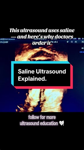 A saline ultrasound gives a clearer look inside the uterus by gently outlining the cavity with saline. Simple, informative, and commonly ordered. 🤍 #ultrasoundtech #womenshealth #fertilitytesting #sonohysterogram #TikTokCreatorSearchInsightsIncentive