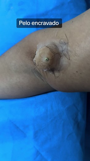 Alerta sobre pelos encravados: como tratar corretamente