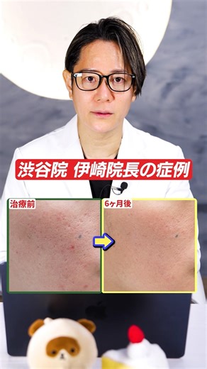 Here are some case studies of the Hanafusa method for treating acne scars at Hanafusa Dermatology...