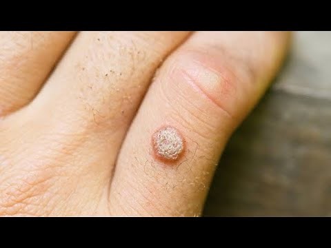 Thuja Occidentallis! Homeopathic medicine Thuja Occidentalism?