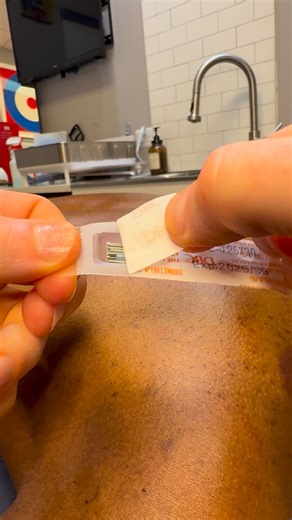 119K views · 488 reactions |  Dry needling uses a thin needle to target trigger points and release stubborn muscle tension. It’s ideal for chronic pain, nerve irritation, and mobility issues that stretching just won’t fix. Feel the relief and reset your body naturally. #DryNeedling #MuscleRecovery #TriggerPointRelief #ChiropracticCare #SportsPerformance #drkyleross | Dr_kyleross | Facebook