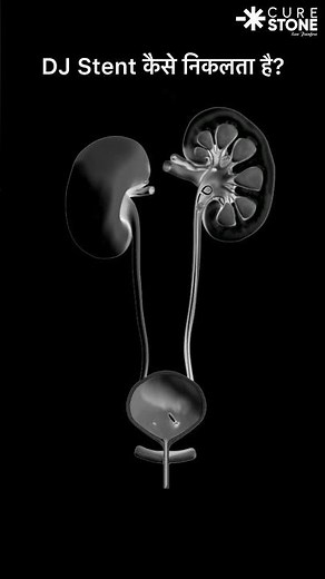 How DJ stent is removed | How much pain | #urology