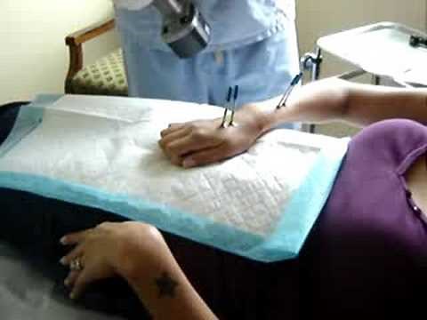 External Fixator Removal Part1