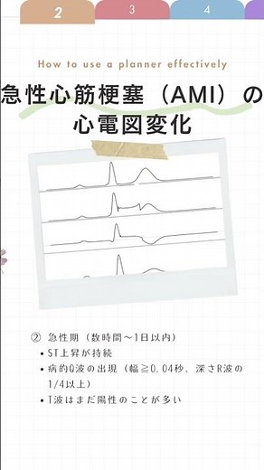 心筋梗塞の心電図ST上昇急性心筋梗塞を最も疑う所見病的Q波心筋壊死を示すT波の変化超急性期は「テント状陽性T波」亜急性期は「陰性T波」👉#心電図 #看護師