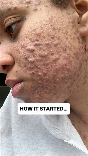 ACTIVE ACNE VS POST INFLAMMATORY HYPER PIGMENTATION #skincare #acne #viralshorts
