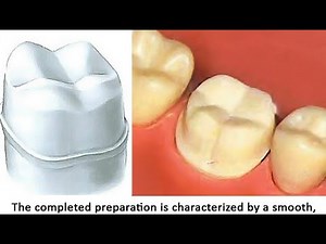 crown preparation lower 6 full metal