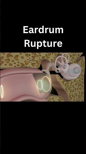 Ruptured Eardrum | 3D Animation 👂