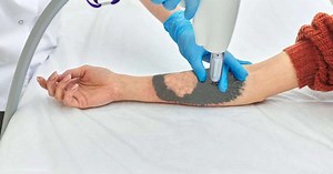 Remoção de tatuagem com laser: como funciona?