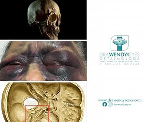 SIGNO DE OJOS DE MAPACHE. Se caracteriza por la presencia de Equimosis Periorbitaria bilateral. Es resultado de acúmulo de sangre después de una fractura de Base Anterior del Cráneo. Recordemos que la base del craneo tiene varios agujeros por los que pasan vasos sanguíneos y nervios. Por eso, una fractura produce este tipo de equimosis. Tambien se evidencian fugas de liquido cefalorraquídeo por nariz y oídos. #eyetrauma #traumaocular #oculartrauma #drawendyreyes #aptoonline #craneo #neurosurgery