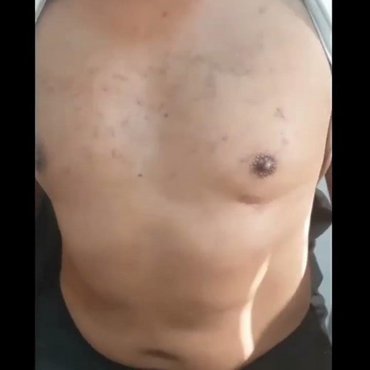 Épilation au laser pour hommes