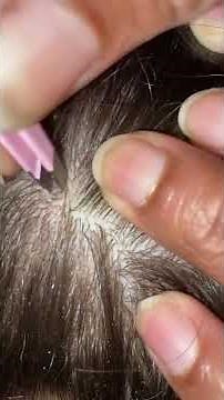 Scab picking! Old hard scab