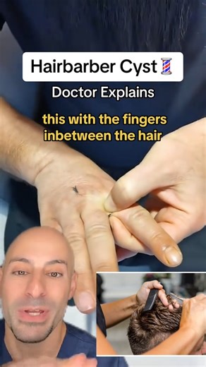 David Abbasi, MD | Orthopedic Sports Surgeon on Instagram: "Did you know about the barber's cyst? #interesting ✅Follow @drdavidabbasi for More Daily Medical Content & Health Tips! 🌴😷Schedule a consultation to see Dr. Abbasi as a patient in Delray Beach! Visit www.primeorthocenter.com"