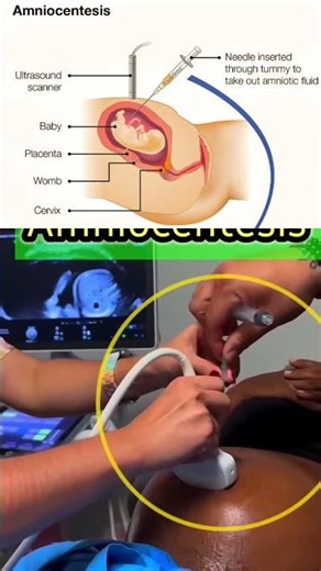 Amniocentesis Procedure use of Fetal congenital abnormalities #patientcare #nursing #viralshorts