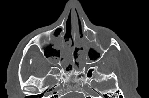 Dear Doctor: Are blood thinners causing my low hemoglobin level?