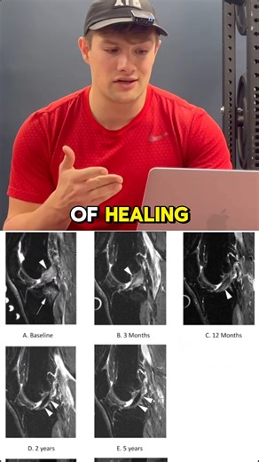 Fully Torn ACLs can heal without surgery… BETTER than an ACL Reconstruction?! 😱 #acl #sports