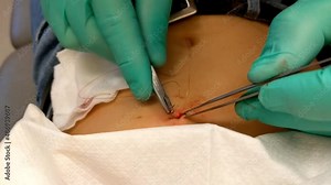 Stitching lesion after benign skin lesion, mole removal. Fibroepithelial Polyp on Abdomen