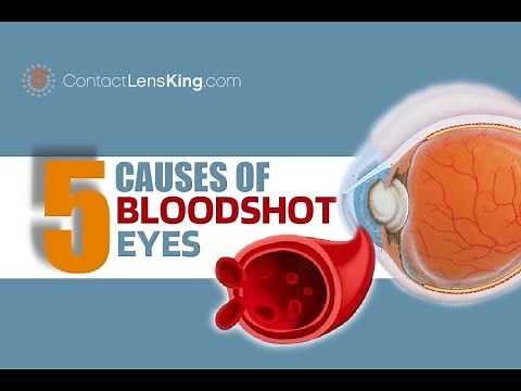 Bloodshot Eyes | 5 Causes of Bloodshot Red Eyes