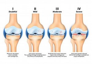 Osteoarthritis Treatment | Oxford Orthopaedics