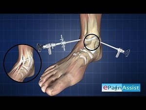 Ankle Arthroscopy-Diagnostic Procedure