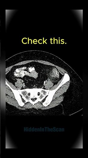 Acute Diverticulitis on CT⚠️