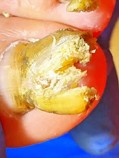 39K views · 275 reactions | Long toenails the trimming process and ingrown cleaning #longtoenails #thicktoenails #Ingrown #Pedicure #toenails #Toenailfungus #nail #cleannail #warts #cleaner #toenailremoval #ingrowntoenailremoval #fblifestyle Disclaimer: Videos do not show original ingrown nails,they are used for education purpose. Thank You,,, | Sathi | Facebook