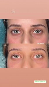 Comblement des cernes à l’acide hyaluronique 👁️ “SOYEZ LA MEILLEURE VERSION DE VOUS MÊME” 🥰 | Dr.Hachichi