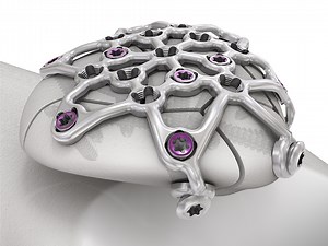 VA Locking Patella Plating System