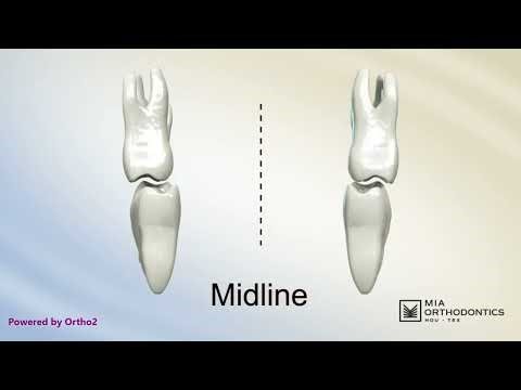 Unilateral Posterior Crossbite Explained: Functional Shift & How Expansion Fixes It