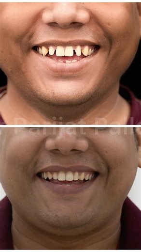 Closing large gaps and improving gum health with orthodontic treatment. #healthysmile #dentalclinic