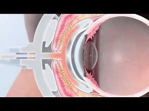 LipiFlow treatment Cross Section