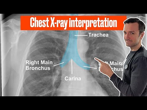 Chest X ray interpretation (in 10 minutes) for beginners🔥🔥🔥 #chestxray #cxr