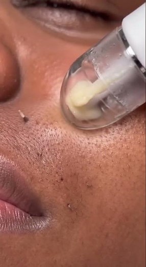 “What Happens When You Extract a Blackhead”