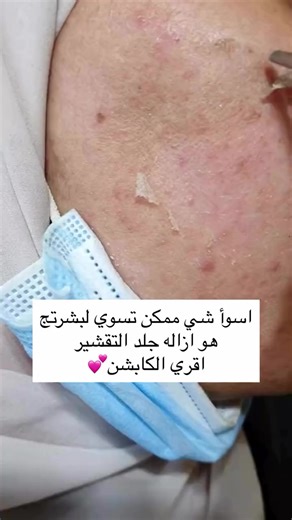 اكثر الاخطاء التوكعون بيهه هي ازالة الجلد اللي يريد يوكع متعرفون انتوا بهاي الخطوه كاعد تاذون البشره بدل ما تصلحوهه لان بهاي الحاله الجلد راح يحمي نفسه لان انزال بالغصب وراح يطلع النه طبقه تصبغات للخارج ف اتركو هو يوكع برااااحتة وبس❤️ احبكم