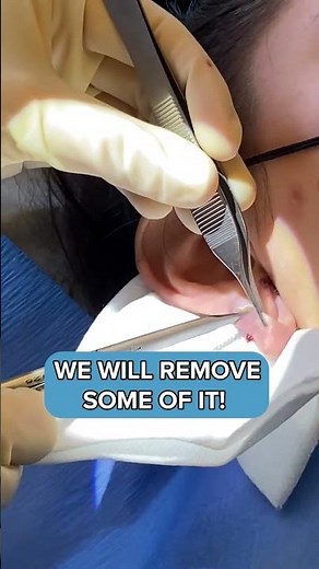 Stretched Ear Lobe repair by Dr. F Caron @ Clinique Evolution - réparation lobes oreilles