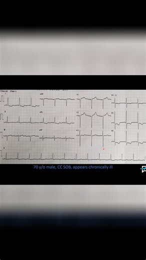 Practical EMS on Instagram: "Subtle ST elevation in V1/V2. T wave inversion in V5/V6. Possible ischemic changes. Requires further investigation. #EKGInterpretation #Ischemia #Infarction #Cardiology #STEMI #EKG"
