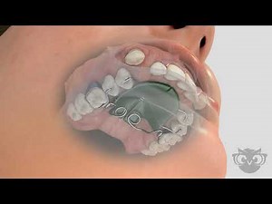 Orthodontic Distalizer