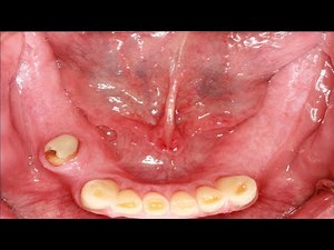 how to get rid of gag reflex with dentures