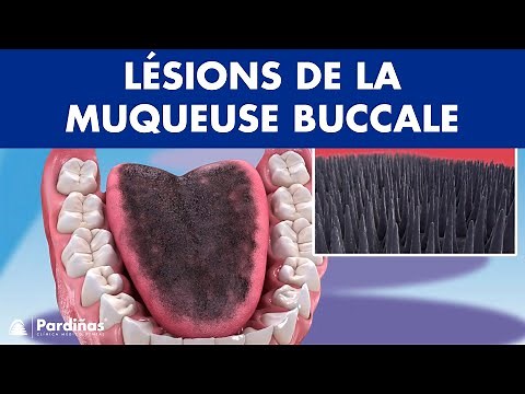 Langue géographique, lichen plan, leucoplasie et autres lésions de la muqueuse buccale ©