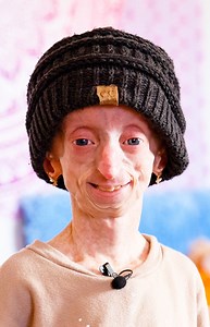 I'm 18 - But I only weigh 35lbs | Born Different