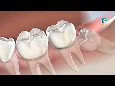Post-Operative Instructions: Wisdom Teeth Removal | Pacific Northwest Oral & Maxillofacial Surgeons