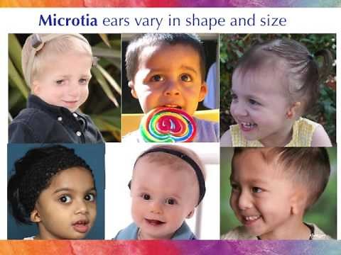 Microtia Awareness