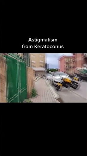 Keratoconus Vision Simulation #keratoconus #shorts Treatment info www.KeratoconusInserts.com